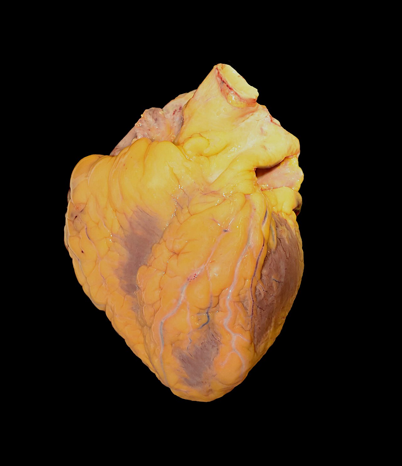 Photograph of a real human heart covered in yellow epicardial fat